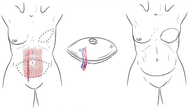 DIEP Flap Breast Reconstruction in Washington, DC - Breast