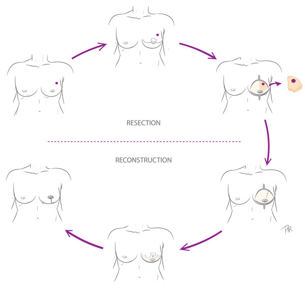 Partial Mastectomy diagram