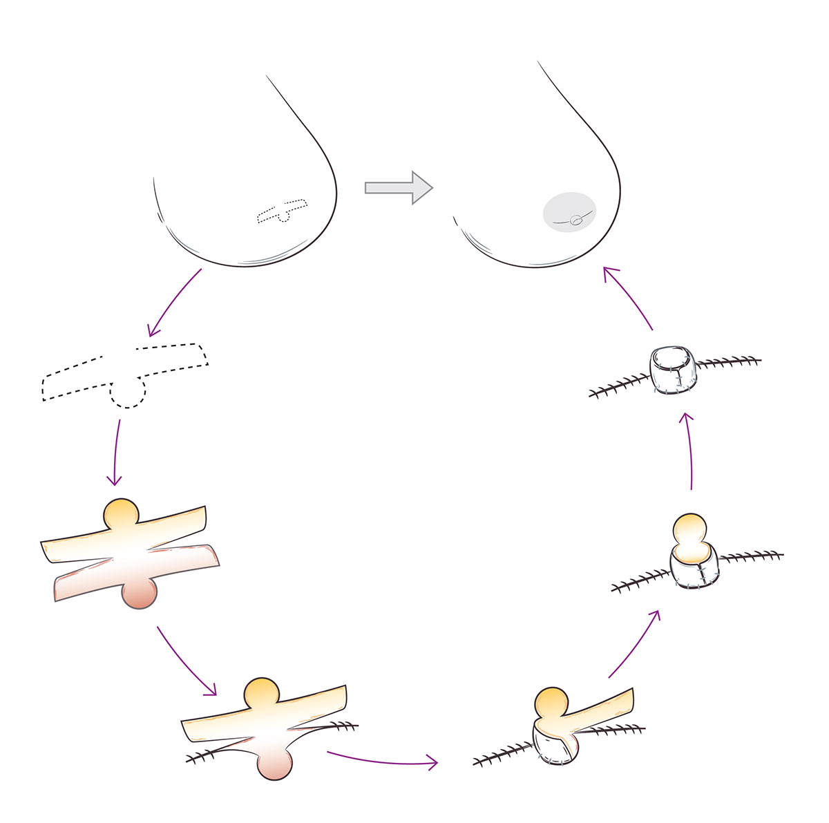 Nipple Reconstruction Illustration