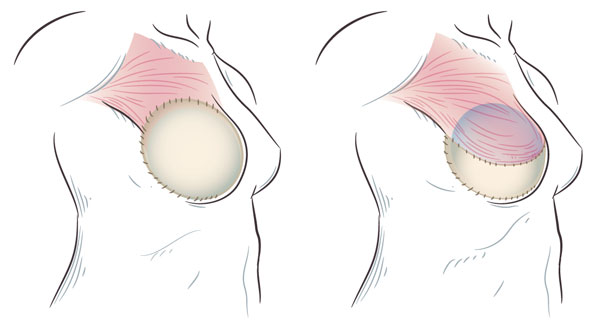 implant placement