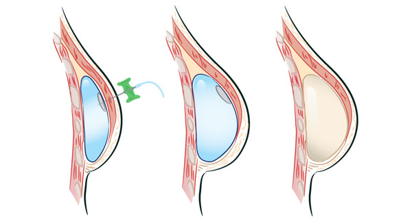 Breast implant insertion diagram