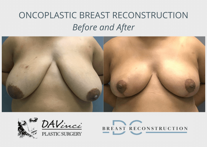 Before and after results of oncoplastic breast reconstruction 