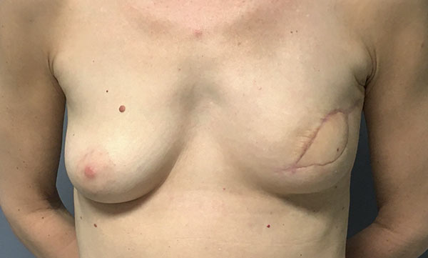 Patient after breast reconstruction