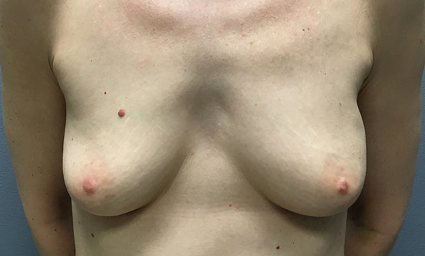 Patient before breast reconstruction