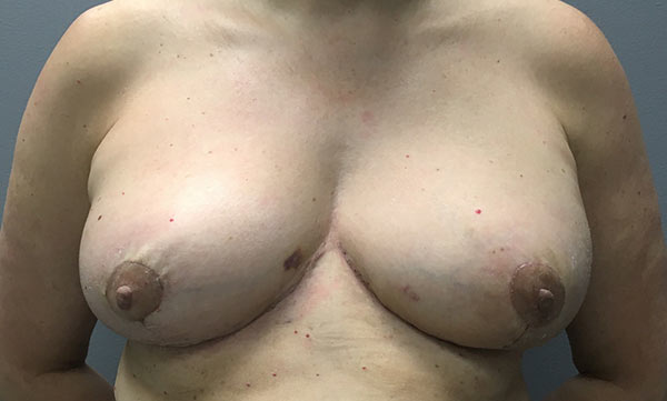 patient after breast reduction
