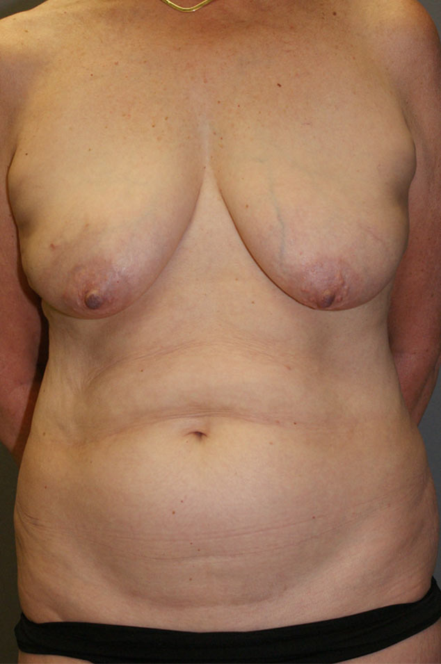 Patient after mastopexy